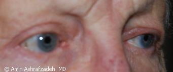 Image of patient after eyelid surgery, blepharoplasty
